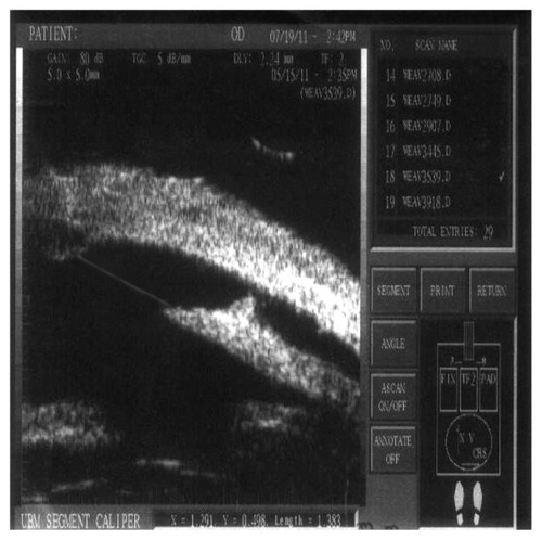 Figure 12 A visible aqueous drainage route = 1.383 mm.