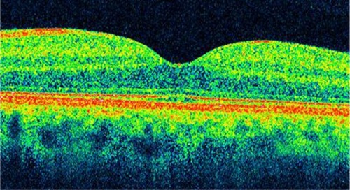 Figure 3 Optical coherence tomography image shows a normal foveal contour.
