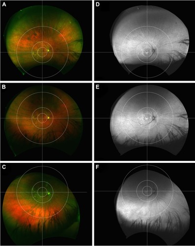 Figure 3 Patient with age-related macular degeneration and widespread perimacular and peripheral abnormalities. Ultra-widefield pseudocolor images of the right eye demonstrate foveal retinal pigment epithelium (RPE) changes along with macular drusen in all quadrants. There are extensive drusenoid changes in the perimacular area in the temporal quadrants, as well as mid-peripheral and far-peripheral drusen and RPE changes (A–C). Analogous to this, ultra-widefield autofluorescence shows mixed hyper/hypoautofluorescence in the macula and hyperautofluorescence in the perimacula. The mid- and far periphery show partially mottled hyperautofluorescence (D–F). Upgaze (A and D); primary gaze (B and E), downgaze (C and F).