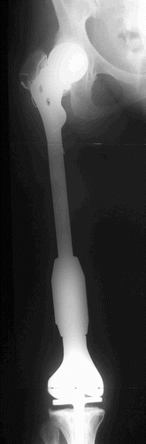 Figure 3. Postoperatively: the knee construct attached to the prosthetic femoral segment.