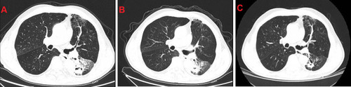 Figure 1 (A) CT revealed large dense shadows and cavity formation in the inferior lobe of the left lung. (B) The results of CT re-examination suggested that, the area of infection in the inferior lobe of the left lung was significantly reduced and the cavity was smaller. (C) The condition of the lung was further improved than before.