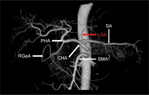 Figure 4 LGA originating from aorta.