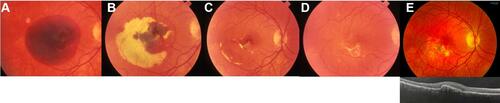 Figure 2 49-year old female with presumed ocular histoplasmosis syndrome (POHS) of the right eye. (A) On presentation, fundus photograph of the right eye revealed a large, thick SMH. There was no OCT imaging or anti-VEGF treatment agents available in 1989. (B) During one-month follow-up, while some of the hemorrhage had been resorbed, there was persistent dehemoglobinized blood. (C) At three-month follow-up, the hemorrhage had mostly resolved with minimal retinal pigment epithelial changes. (D) Two years later, hemorrhage was resolved completely with inferior subretinal fibrosis. (E) At 30-year follow-up, fundus photograph demonstrated pigmented fibrosis and the OCT showed a shallow RPE detachment without subretinal fluid.