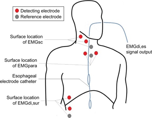 Figure 1 Schematic diagram of the position of the multipair esophageal electrode and surface electrode.