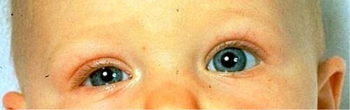 Figure 4 Infant with right Horner syndrome, demonstrating ipsilateral upper lid ptosis, “upside-down” ptosis of the lower lid, and anisocoria, with the right pupil smaller than the left. Both pupils reacted briskly to light stimulation.