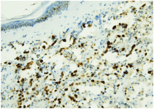 Figure 4. Ki-67 immunostain (40x), this picture shows strong nuclear positivity of neoplastic cells >20%. antigen KI-67 is a nuclear protein that is associated with cellular proliferation and ribosomal RNA transcription. The Ki-67 percentage score is defined as the percentage of positively stained tumor cells among the total number of malignant cells assessed.