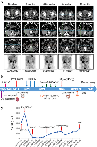 Figure 1 Clinical course of the patient. (A) Serial PET/CT images of primary tumor lesion, liver metastasis, abdominal lymph node metastasis and reconstruction of coronal plane at different stages of treatment; (B) Timeline of clinical events. (C) Level of CA199 during the treatment.