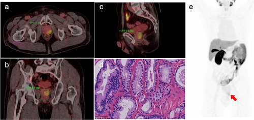 Figure 2. A 67-y-old male with prostate acinar adenocarcinoma (International Society of Urological Pathology grade 1; Gleason Score: 3 + 3 = 6; PSA = 8.78 ng/ml), with 18F-PSMA-1007 PET/CT images depicting manually drawn volume of interest (VOI) for major lesion in three planes and a two-dimensional ROI in the right gluteus maximus. A. Axially fused PET/CT, SUVmax: 5.75, SUVmean: 3.42, iPSMA-TV: 6.45 cm3, iTL-PSMA: 22.06 cm3, TBR: 6.85. There was a mild concentration of the imaging agent at the prostate cancer site. B. Sagittal fused PET/CT. C. Coronally fused PET/CT. D. Pathological images, HE staining (×400); gland presented acinous, with different sizes and shapes, and single glandular duct arrangement, and the cytoplasm was slightly dichroic. E. MIP image.