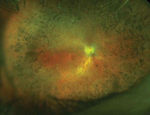 Figure 1. OPTOS image of a male RPGR patient showing the typical peripheral ‘bone spicule’ like pigmentary changes and signs of foveal atrophy. The inner retinal vessels are also attenuated due to the loss of outer retinal cells (photoreceptors) through physiological autoregulation of blood supply – this is not believed to be pathogenic.