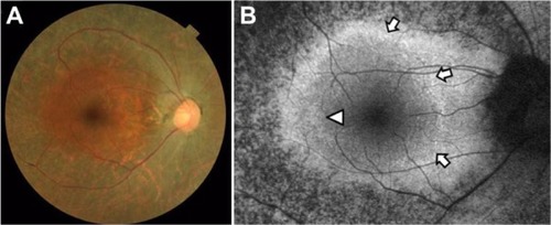 Figure 5 Color fundus photograph (A) and short-wavelength fundus autofluorescence photograph (B) of the right eye in case 2. Arrows show an incomplete parafoveal ring of high-density fundus autofluorescence (B). The arrowhead shows the inner border of the high-density fundus autofluorescence ring (B).