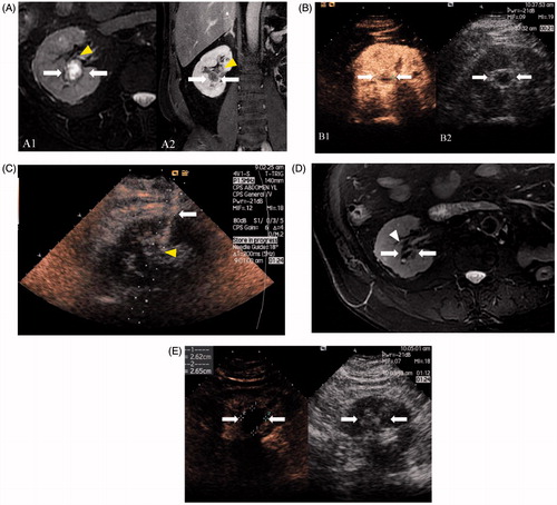 Figure 2. Images in a 68-year-old man with 1.9 × 1.7 cm RCC treated by CEUS-guided percutaneous MWA. (A) MRI shows a complex cystic mass (arrows) adjacent to the pelvis (arrowheads) in the right kidney in T2 and contrast-enhanced MRI shows an enhancement in the tumour solid part (arrows). (B) The tumour boundary and solid part were inconspicuous on conventional US while the CEUS cortical phase image shows a 1.9 × 1.7 cm tumour in the right kidney (arrows) and the tumour boundary was confidently detectable on CEUS. (C) Microwave antenna (arrow) was inserted into the lesion (arrowheads) accurately under CEUS guidance. (D) MRI obtained 14 months after CEUS-guided percutaneous MWA shows complete necrosis of the tumour (white arrows) and pelvis (arrowhead) was not injured. (E) Cortical phase of CEUS obtained 14 months after CEUS-guided percutaneous MWA shows complete necrosis of the tumour (arrow).