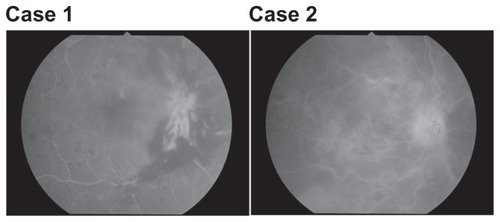 Figure 1 Fluorescein angiography. Case 1: macular edema without macular ischemia. Case 2: macular edema associated with ischemia of the macular region.