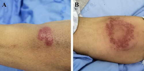 Figure 1. (A) Red plaques and nodules on the forearm. (B) Circular red plaques with nodules at the edge of the forearm.