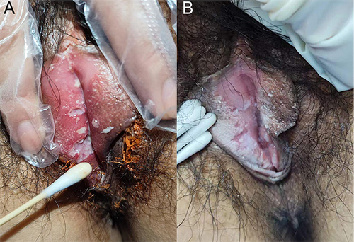 Figure 1 (A) Necrotic and fibrinous genital ulcers. (B) Follow-up image after 14 days of therapy demonstrating a resolving ulcerated lesion and vulvar edema.