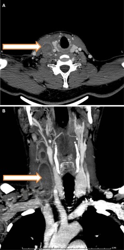 Figure 1 CTA of the neck revealing thrombosis of the right IJV (arrow); (A) axial and (B) coronal.