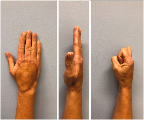 Figure 3. Photograph of the affected hand in two planes two years postoperatively.