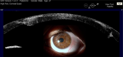 Figure 5 A 27-year-old male patient had penetrating keratoplasty in his left eye 2.5 years earlier; the preoperative diagnosis was also keratoconus.