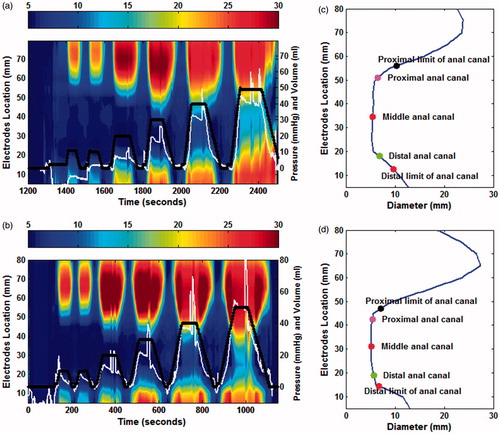 Figure 1. Spatio-temporal diameter map of the anal canal from a patient with anal cancer (a) and a healthy volunteer (b). The changing colors from blue to red illustrate increasing diameter. Each column, depicts the configuration of the anal canal at a specific time and each row depicts change in diameter over time at a particular point along the FLIP probe. The vertical axis on the left represents the length of the anal canal and the right side represents the pressure (thin white line) and volume (heavy black dot line). (c) & (d), the configuration of the anal canal in (a) and (b) at the initial state with the visually defined proximal and distal limits and the computed points representing the proximal, middle and distal parts of the anal canal.