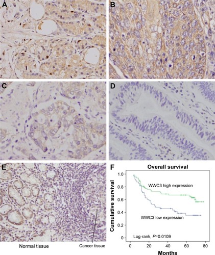 Figure 1 Expression pattern of WWC3 protein in gastric cancer tissues.