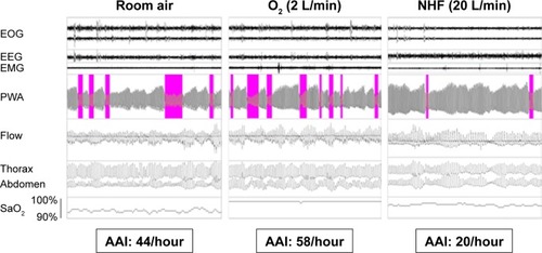 Figure 1 Example of changes in PWA during REM sleep in one COPD patient on three different conditions: RA, O2 supplementation, and NHF treatment.Notes: Autonomic activation events were defined as a reduction in PWA of 30% or more compared to a prior baseline period. Automatically scored autonomic activation events are highlighted in the pulse wave tracings.Abbreviations: AAI, autonomic activation index; EEG, electroencephalogram; EMG, electromyogram; EOG, electrooculogram; NHF, nasal high flow; PWA, pulse wave amplitude; RA, room air; REM, rapid eye movement.
