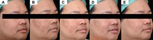 Figure 2 Postoperatively treated side with the sunscreen A. (A) Baseline, (B) 1-week 1, (C) 2-week, (D) 4-week, and (E) 6-week follow-up visit.