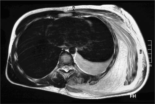 Figure 3. MRI showing a diffuse inflammatory swelling of the back and postero‐lateral chest wall musculature with a reactive pleural effusion.