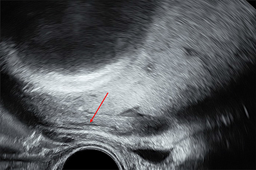 Figure 4 Transvaginal ultrasound in April 2023 during the third trimester of pregnancy, depicting the area of the anterior uterine wall to the left. The bladder, which is closest to the ultrasound probe, is almost empty. Cranial to the bladder is the part of the anterior uterine wall where the cystic adenomyoma was located on the previous scans (red arrow), however, at this point during pregnancy it is no longer visible. The caudal edge of the placenta and the fetal head are also visible.