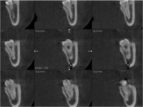 Figure 1. The MC is visible on two slices (open arrow), therefore, was given a score of 1 (good visibility).