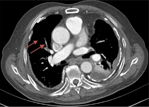 Figure 2 Right lung branch pulmonary embolism, mainly involved pulmonary artery (arrow).