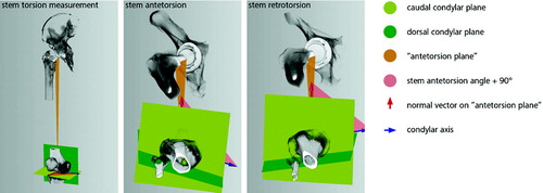 Figure 1. Stem antetorsion measurement. The mechanical axis was defined by 2 points: the center of the femoral head and the center of the caudal contact points of the femoral condyles. “Antetorsion plane” was defined by a third point on the prosthesis representing the direction of the neck. A caudal condylar plane was created orthogonal to the mechanical axis. The angle between the condylar axis projected on this plane and the normal to the “antetorsion plane” subtracted by 90° gave the torsion angle.