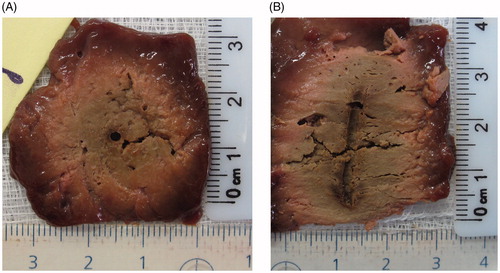 Figure 3. Ex-vivo gross pathology. A representative image of the sectioned liver following a six min RF application using a 3 cm single active tip is presented in transverse (A) and axial section (B). White coagulation measuring 2.7 × 2.7 × 3.3 cm is clearly defined.