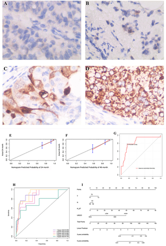 Figure 7 Immunohistochemical results of UBE2C: Under 400x magnification, it was negative (A), weak positive (B), moderate positive (C), and strong positive (D). After UBE2C_mRNA index was replaced by UBE2C_IHC, which is more available clinically, and the calibration curve (E and F), ROC curve (G), time-dependent ROC curve (H) of Model 1 and nomogram diagram (I) were verified again.