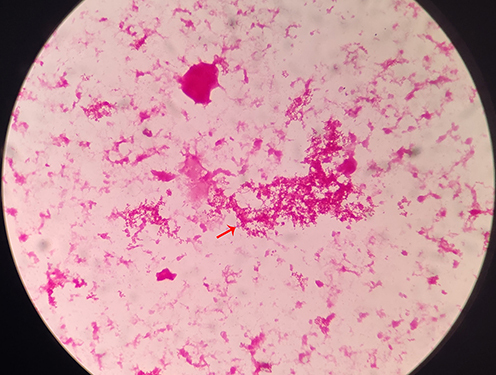 Figure 1 Gram-staining morphological observations of Aggregatibacter aphrophilus under the microscope. The red arrow indicates the morphology.