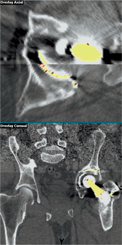 Figure 1. Superimposed axial (close‐up) and coronal (overview) slices through bone and an unstable cemented prosthesis after registration of two CT volumes. The top half of each image is the reference volume; the bottom half is the volume that has been moved so that the pelvis is in the same position using image registration (the “transformed volume”). Note that there is no mismatch in the bone morphology between the volumes, indicating that the pelvis is in almost the same position in both scans. The implant is not matched, however, indicating movement.