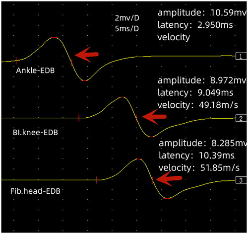 Figure 2. Nerve conduction graphs of the peroneal nerve stimulation showing the amplitudes, latencies, and nerve conduction velocities which returned to normal values.