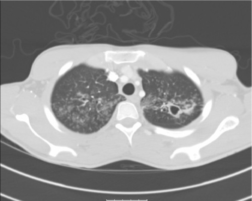 Figure 1 CT of the chest (in lung window) showing multiple thick-walled cavities in both upper lobes with diffuse tree-in-bud nodularities.