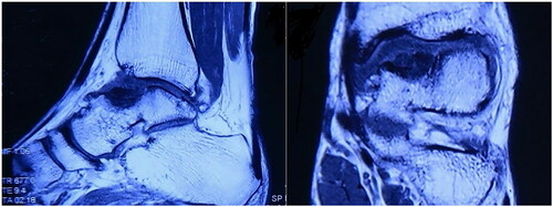 Figure 3. Magnetic resonance imaging revealing the destruction of the talus with collapse.