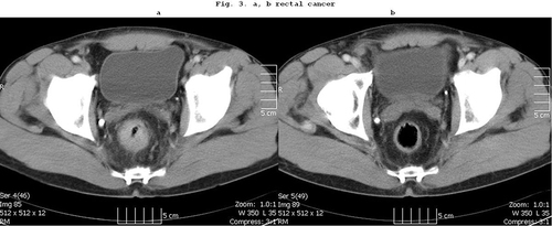 Figure 3 (a) CT scan of a T3N1 middle third rectal cancer. (b) Complete clinical response is achieved after preoperative chemoradiation.