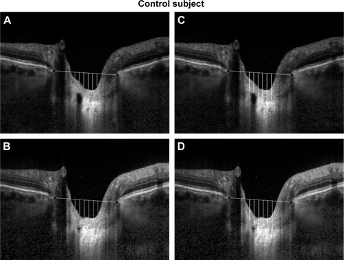 Figure 4 Vertical distances from the line connecting the Bruch’s membrane ends to the anterior surface of the lamina cribrosa and the prelaminar tissue at baseline (A and C) and during IOP elevation (B and D) in a control eye.