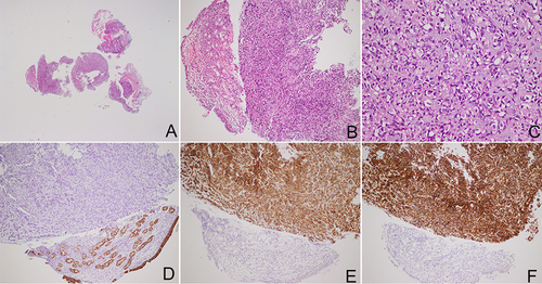 Figure 3 Histomorphology and immunohistochemistry results of consultation sections. (A-C) The consultation sections showed sheets of epithelioid cells in the submucosa, and vacuolization was seen; (D-F) the immunohistochemical results showed the tumor cells were negative for CK-pan (D), and were positive for CD117 (E), DOG1 (F) [figures magnification: A,40x; C,400x; other figures,100x].
