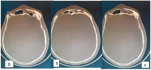 Figure 2 Brain CT scan bone window demonstrating old left frontal sinus fracture (D) with partially opacified frontal sinuses and erosion of frontal bone due to the mucocele (E and F).
