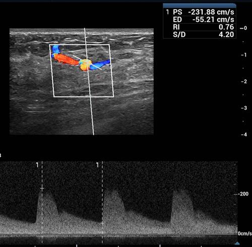 Figure 3 Spectral Doppler demonstrated a high-velocity arterial flow inside.