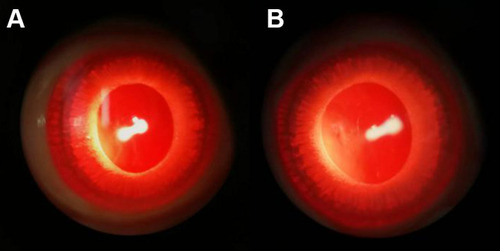 Figure 3 The representative result of Draize test on 7th day (A:the gel group, B:the control group).
