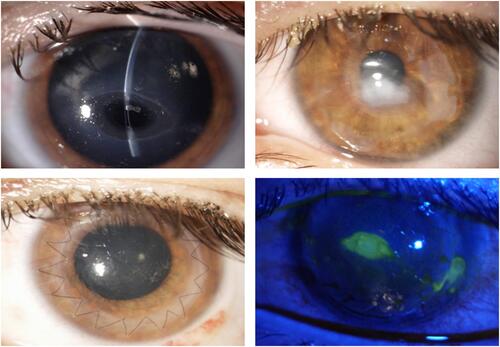 Figure 1 Ocular surface findings in a 24-year-old woman with descemetocele following acoustic neuroma surgery. Slit-lamp examination showing images of the left eye presenting severe NK with a large paracentral descemetocele (top left) that was treated in emergency with a multilayer AMT. Three months after surgery the patient presented with a dense corneal leucoma (top right) requiring an optic PK (bottom left). Two weeks after PK a NK recurrence was observed (bottom right) with a central oval ulcer and a peripheral thinning on the suture. Treatment with cenegermin was initiated.