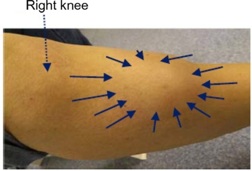 Figure 4 Skin manifestation of calciphylaxis. Right distal leg 3 months postcinacalcet treatment (note a large indurated area tender on touch with normal color, indicated by the continuous arrows).