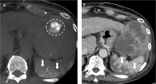 Figure 7 Recurrent HCCs in a 70-year old man with HBV cirrhosis of liver and HCC in the both lobes of the liver received TACE before. (A) After the chemoembolization of splenic artery with drug-eluting beads, the nonenhanced CBCT after TACE showed contrast retention in the spleen (arrows), indicative of nontarget embolization. Also note contrast retention in the HCC located in the left lateral segment of liver (dotted line). (B) The follow-up CT one month after TACE showed wedge-shaped poor-enhancing area (arrows) in the spleen on portal venous phase, compatible with splenic infarction caused by nontarget embolization during TACE.