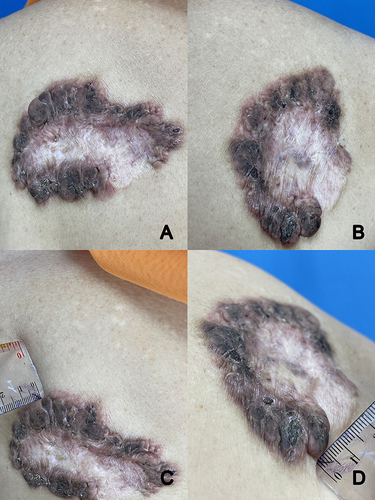 Figure 3 Lesion after 4 sessions (A–C). The thickness had been decreased to 0.5 cm (D).