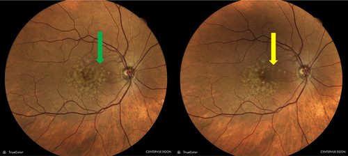 Figure 3 Patient underwent photobiomodulation therapy using the Valeda Light Delivery System and showed a reduction in drusen at the 1-year follow-up examination. Retinography showing the comparison before (green arrow) and after treatment (yellow arrow).