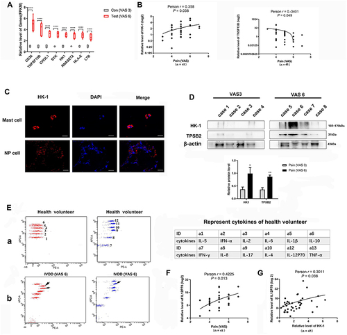 Figure 5 The high expression of the mast cell-related gene HK-1 is closely correlated with discogenic LBP. (A) The expression of mast cell-related genes from RNA-seq results in VAS3 and VAS6 NP tissues.****P < 0.0001. (B) The relationship between HK-1 and TNSF13B with discogenic LBP in 41 NP tissues from IVDD patients of various grades. (C) The localization of HK-1 in mast and NP cells. (D) The protein levels (up) and histogram of gray value statistics (down) of HK-1, mast cell TPSB2 in VAS3 and VAS6 NP tissues *P < 0.05, **P < 0.01. (E) Levels of 12 cytokines in the peripheral venous blood of 41 IVDD patients. a. 12 cytokines distribution in flow cytometry of healthy volunteers act as stand curve (left). The names corresponding to the distribution locations of the 12 cytokines (right table). b. 12 cytokines distribution in flow cytometry of VAS6 - IVDD patient. (F) A high expression level of IL-12P70 is closely related to LBP. (G) Tissue HK-1 expression is correlated with blood IL-12P70 expression.