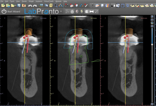 Figure 33. Endo guide planning in BSP cross sectional view.